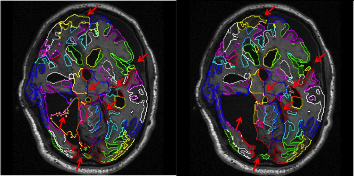 Whole-brain MRI segmentation with MALP-EM in a patient with traumatic brain injury